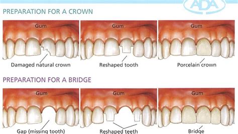 dental bridges rosebud